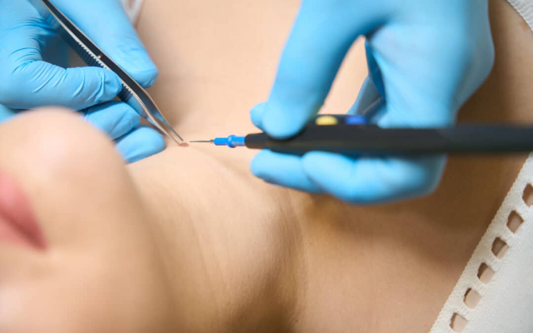 Comment enlever un grain de beauté ?