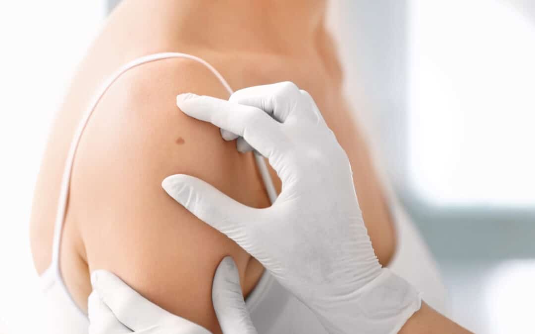 Qu&rsquo;est-ce qu&rsquo;un grain de beauté ? Comprendre ces petites marques.