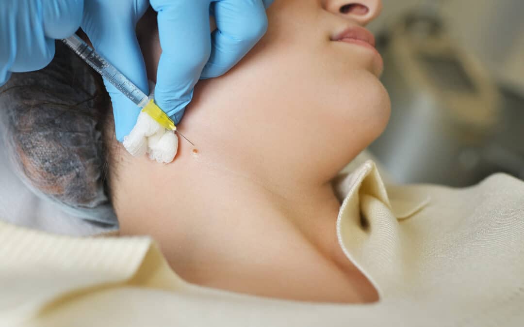 Pourquoi ai-je de nouveaux grains de beauté ? Comprendre et surveiller