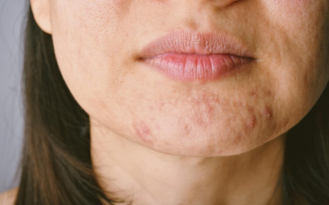 Quels sont les 5 L en dermatologie ?