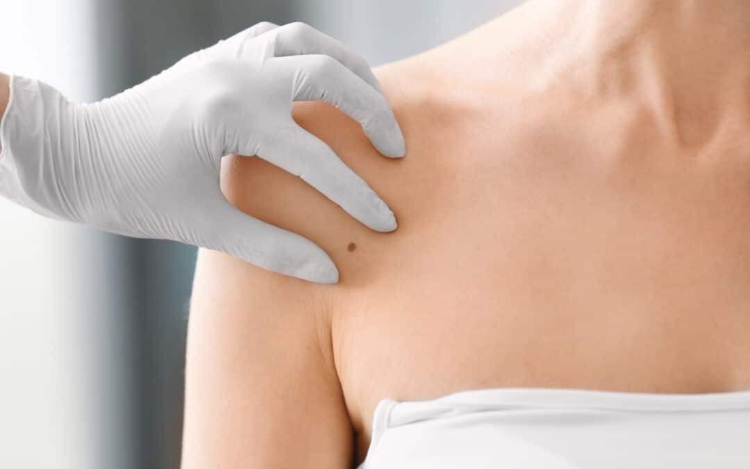 Chirurgien spécialiste grain de beauté, quel est son rôle ?