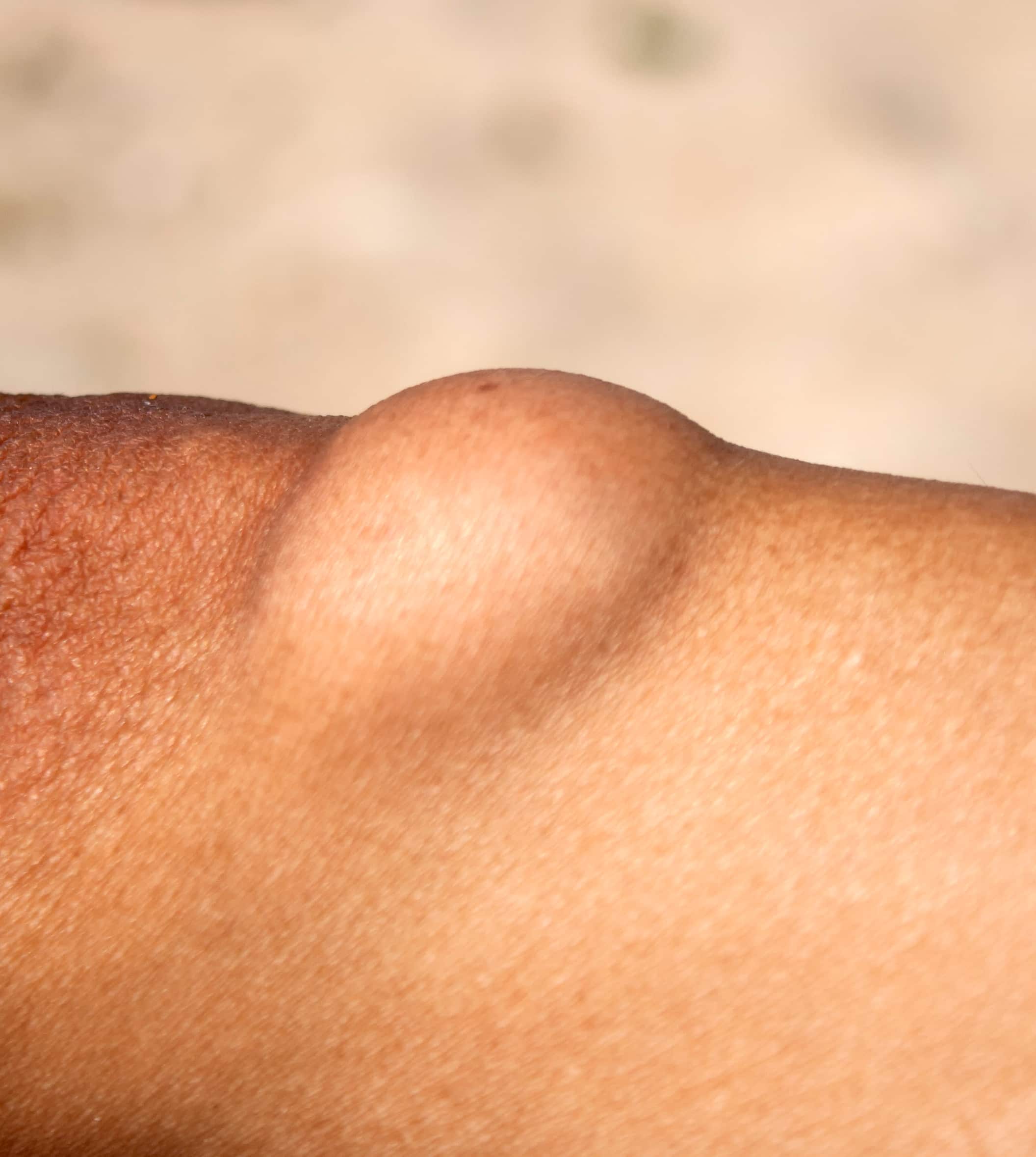 Lipome à la cuisse : Guide complet sur le retrait chirurgical à la Yaphé Clinic