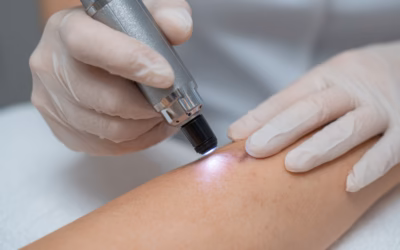 Grain de beauté qui saigne : Pourquoi consulter rapidement un chirurgien ?