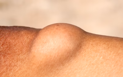 Lipome à la cuisse : Guide complet sur le retrait chirurgical à la Yaphé Clinic