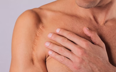 La reprise de cicatrice à Paris : Guide complet pour retrouver une peau harmonieuse