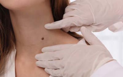Grain de beauté arraché : Urgence, risques et solutions chirurgicales