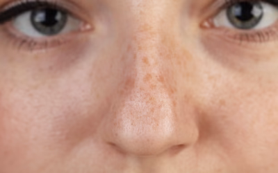 Enlever un grain de beauté sur le nez : Entre sécurité médicale et esthétique