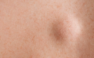 Lipome et stress : existe-t-il un lien réel et quelles sont les solutions ?
