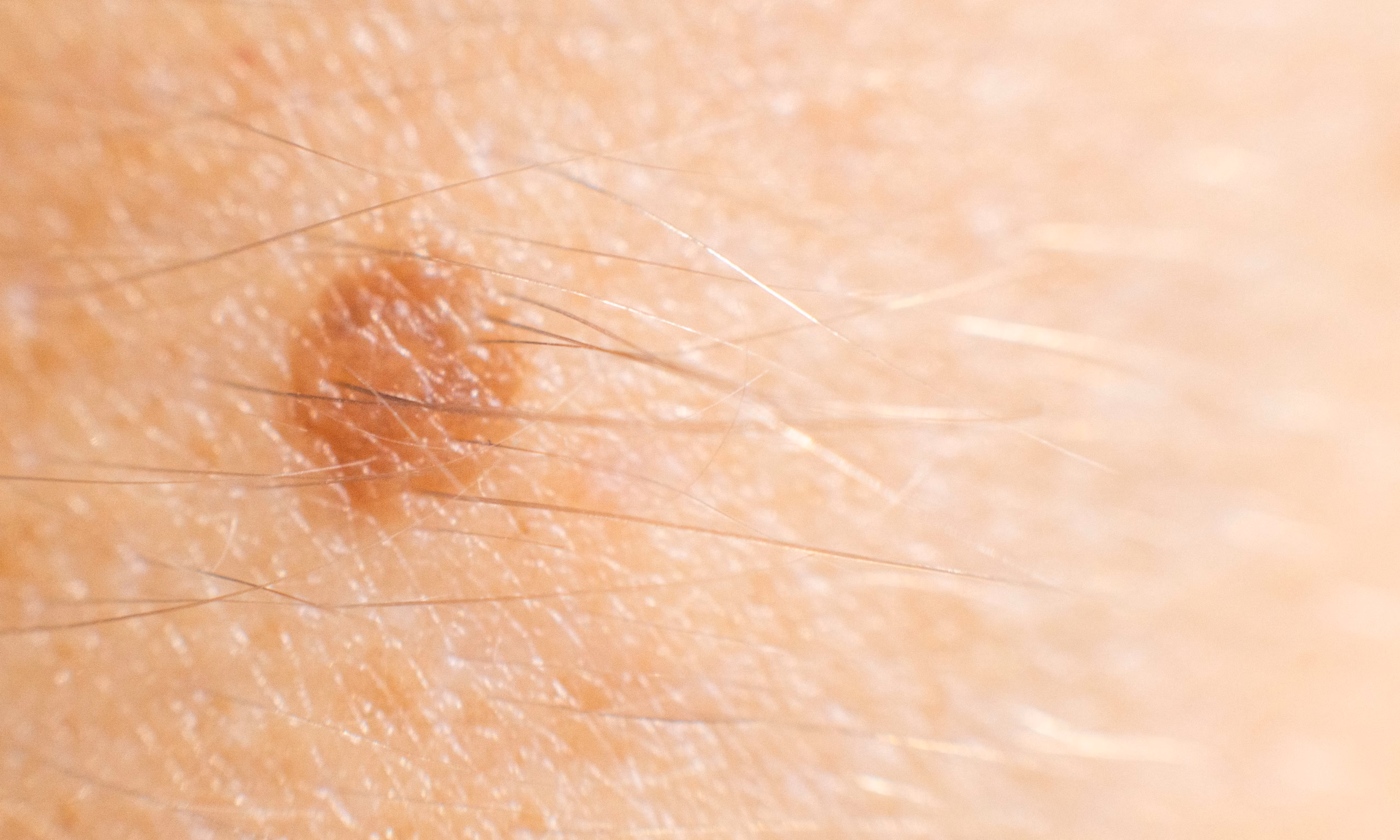 acrochordon ou grain de beauté