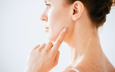 Grain de beauté blanc : causes, symptômes et quand s&rsquo;inquiéter ?