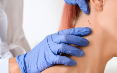 Grain de beauté anormal : comment le reconnaître et réagir ?