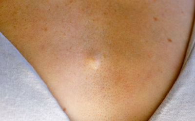 Lipome volumineux ou profond : diagnostic et exérèse de précision à la Yaphé Clinic