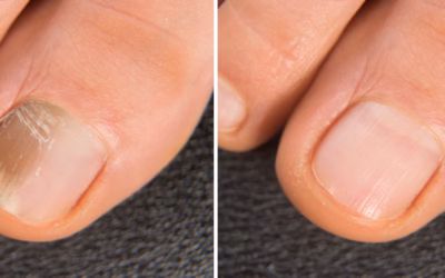 Bande noire ou grain de beauté sous l’ongle : diagnostic et exérèse de pointe à la Yaphé Clinic